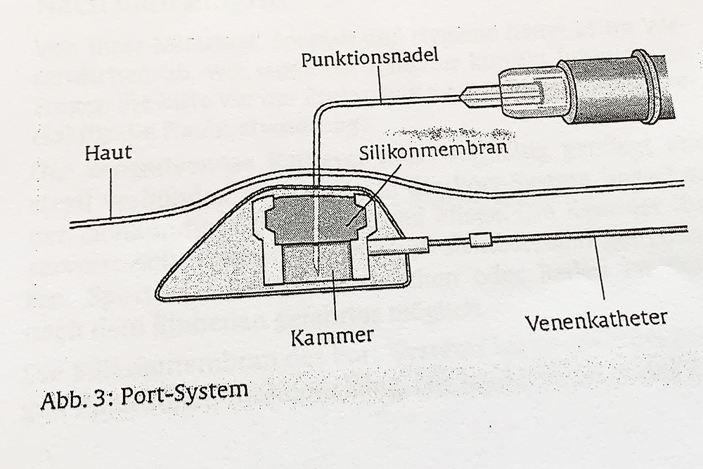 Das Port-System: Haut, Silikonmembran, Punktionsnadel, Kammer und Venenkatheter
